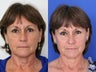 Ultherapy facial skin thightening 