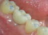 Before and After Case for Dental Implants