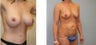 Mommy Makeover Breast Aug. and tummy tuck