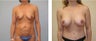 Mommy Makeover Breast Aug. and tummy tuck
