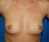 Breast Implants