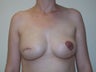 Breast reconstruction with expander and implant