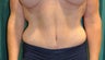 Tummy tuck