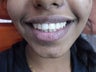 A 17 year old girl treated conservatively and esthetically for fractured front teeth