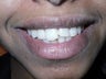 A 17 year old girl treated conservatively and esthetically for fractured front teeth