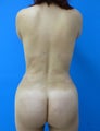 Buttock Augmentation - Brazilian Butt Lift