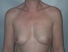 Female patient whose condition was corrected with breast implants 
