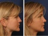 Rhinoplasty revision
