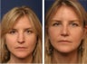 Rhinoplasty revision