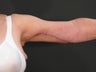 65 Year Old Weight Loss Patient