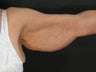 65 Year Old Weight Loss Patient