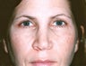 Blepharoplasty