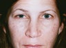 Blepharoplasty