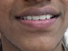 A 22 year old male treated for gaps between teeth