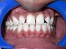 A 22 year old male treated for gaps between teeth