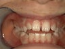 Open bite case