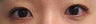 Bilateral Asian Eyelid Surgery