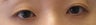 Bilateral Asian Eyelid Surgery