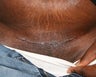C-Section Scar Revision