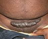 C-Section Scar Revision