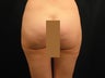 Liposuction