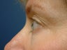 Eyelid Surgery