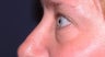Eyelid Surgery