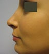 Rhinoplasty