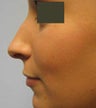 Rhinoplasty