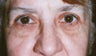 Blepharoplasty
