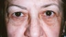 Blepharoplasty