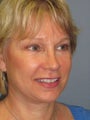 Brow Lift on 50-year-old