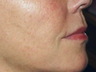 Mesotherapy