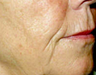 Mesotherapy