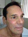 Ulthera and Fillers- before and after