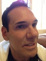 Ulthera and Fillers- before and after
