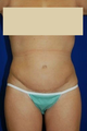 Tummy tuck, Liposuction 