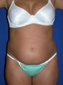 Tummy tuck, Liposuction 