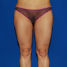 Liposuction
