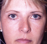 Upper and lower blepharoplasties (eyelid surgery)