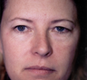 Upper and lower blepharoplasties (eyelid surgery)