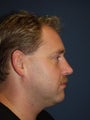 Rhinoplasty