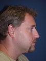 Rhinoplasty