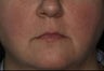 Female Treated for Rosacea/Photoaging