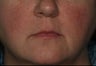 Female Treated for Rosacea/Photoaging