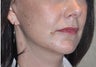 52 Year Old Female Treated For Jowls