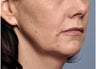 52 Year Old Female Treated For Jowls