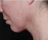Liposuction 