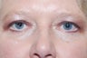 Eyelid Surgery