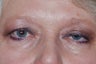 Eyelid Surgery